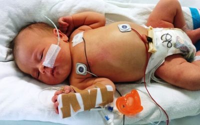 ARDS Infant: A Respiratory Distress Syndrome in Newborn